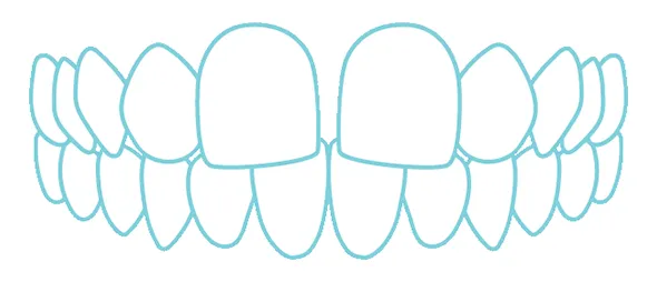 すきっ歯のイラスト