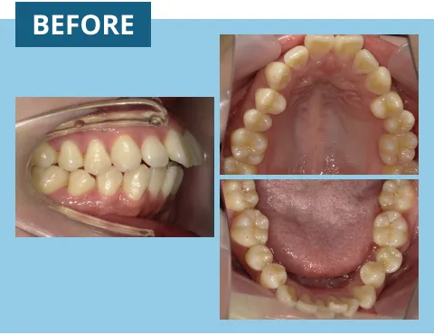 症例紹介:上あごの前の歯が出ている 治療前