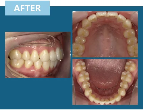 症例紹介:上あごの前の歯が出ている 治療後