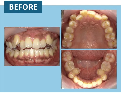 症例紹介:前歯に隙間があり噛めない 治療前