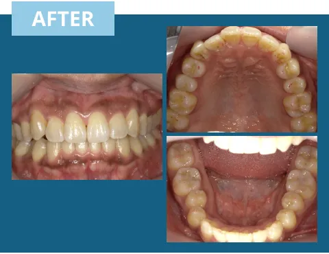 症例紹介:前歯に隙間があり噛めない 治療後