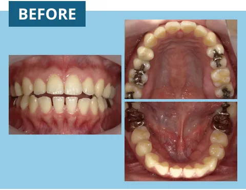症例紹介:前歯のがたつき 治療前