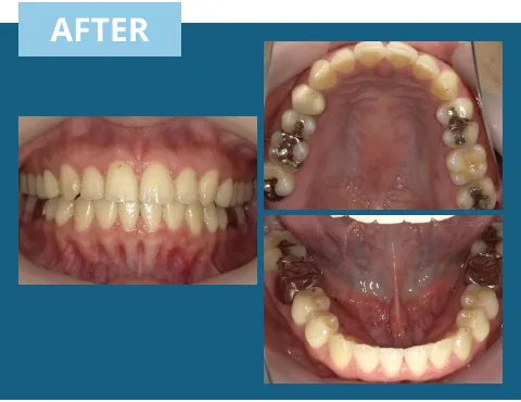 症例紹介:前歯のがたつき 治療後