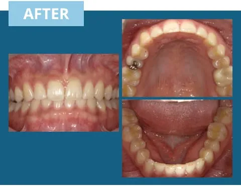 症例紹介:前歯のすきっ歯 治療後