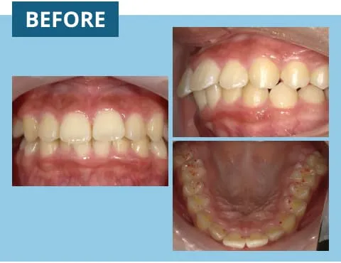 症例紹介:出っ歯 治療前