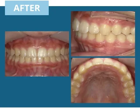 症例紹介:出っ歯 治療後