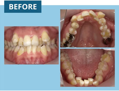 症例紹介:前歯のがたつき 治療前