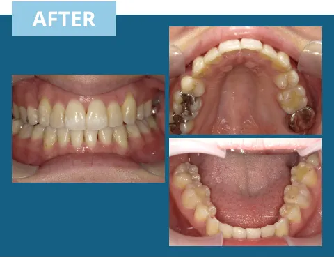 症例紹介:前歯のがたつき 治療後